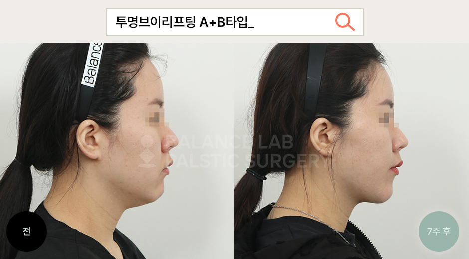 Before 2 Side