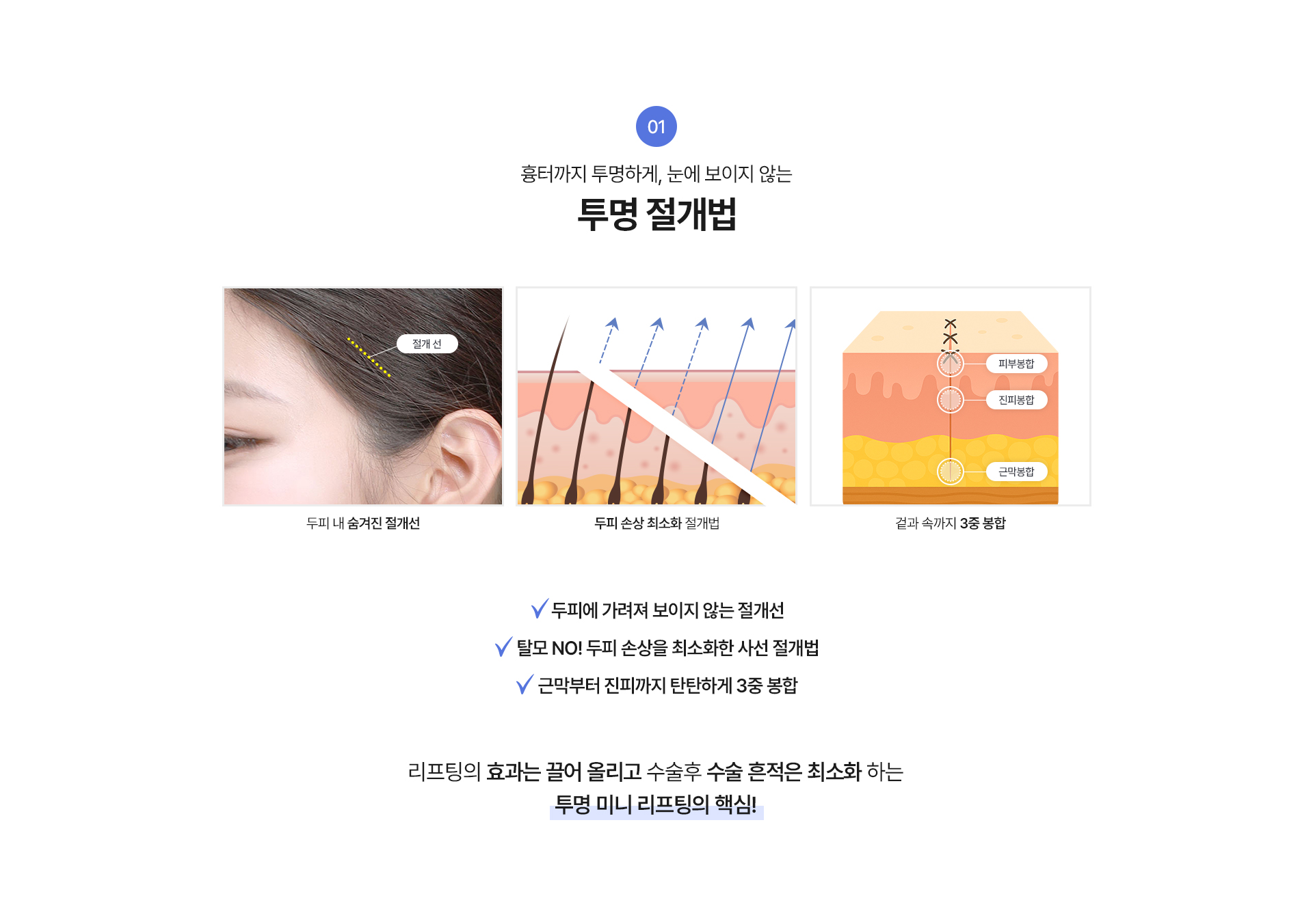 1. 흉터까지 투명하게, 눈에 보이지 않는
투명 절개법
두피 내 숨겨진 절개선, 두피 손상 최소화 절개법, 겉과 속까지 3중 봉합
√두피에 가려져 보이지 않는 절개선
√탈모 NO! 두피 손상을 최소화한 사선 절개법
√근막부터 진피까지 탄탄하게 3중 봉합
리프팅의 효과는 끌어 올리고 수술후 수술 흔적은 최소화 하는 투명 미니 리프팅의 핵심!



