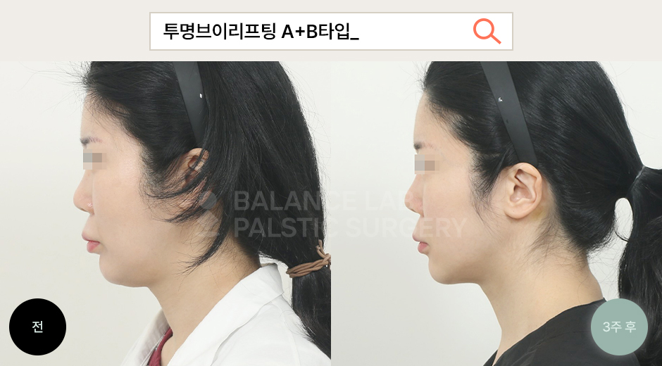 Before 2 Side