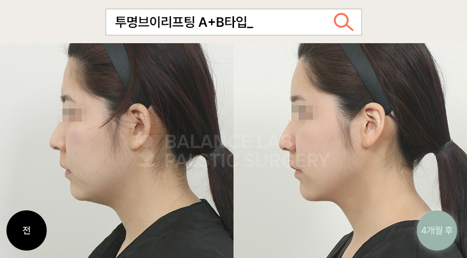 Before 3 Side