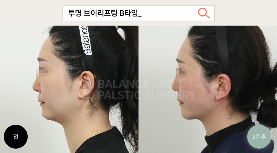 Before 2 Side